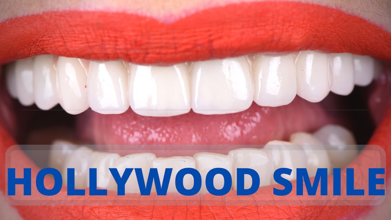 Zubni implanti - All on 4 - Iskustvo pacijenta nakon postavljenih stalnih zuba preko implantata.