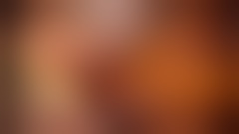 Robotic subxiphoid thymectomy in lymphangioma