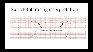 Interpreting Intrapartal fetal heart rate tracings