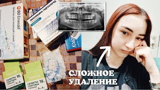 Зуб мудрости, операция и мой опыт сложного удаления // *5 дней со мной*