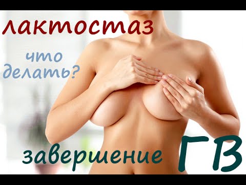 Лактостаз. Завершение грудного вскармливания. Мой неудачный опыт. Лактостаз. Завершение грудного вскармливания. Мой неудачный опыт.