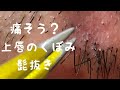 痛そう?上唇のくぼみ【髭抜き】