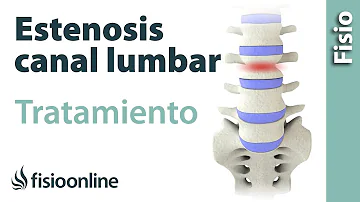 ¿Cuáles son los síntomas de la estenosis L4-L5?