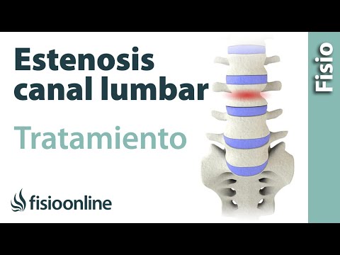 فيديو: La Estenosis Lumbosacra