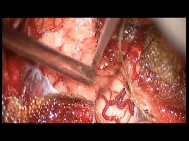 Fourth ventricle choroid plexus papilloma in adult