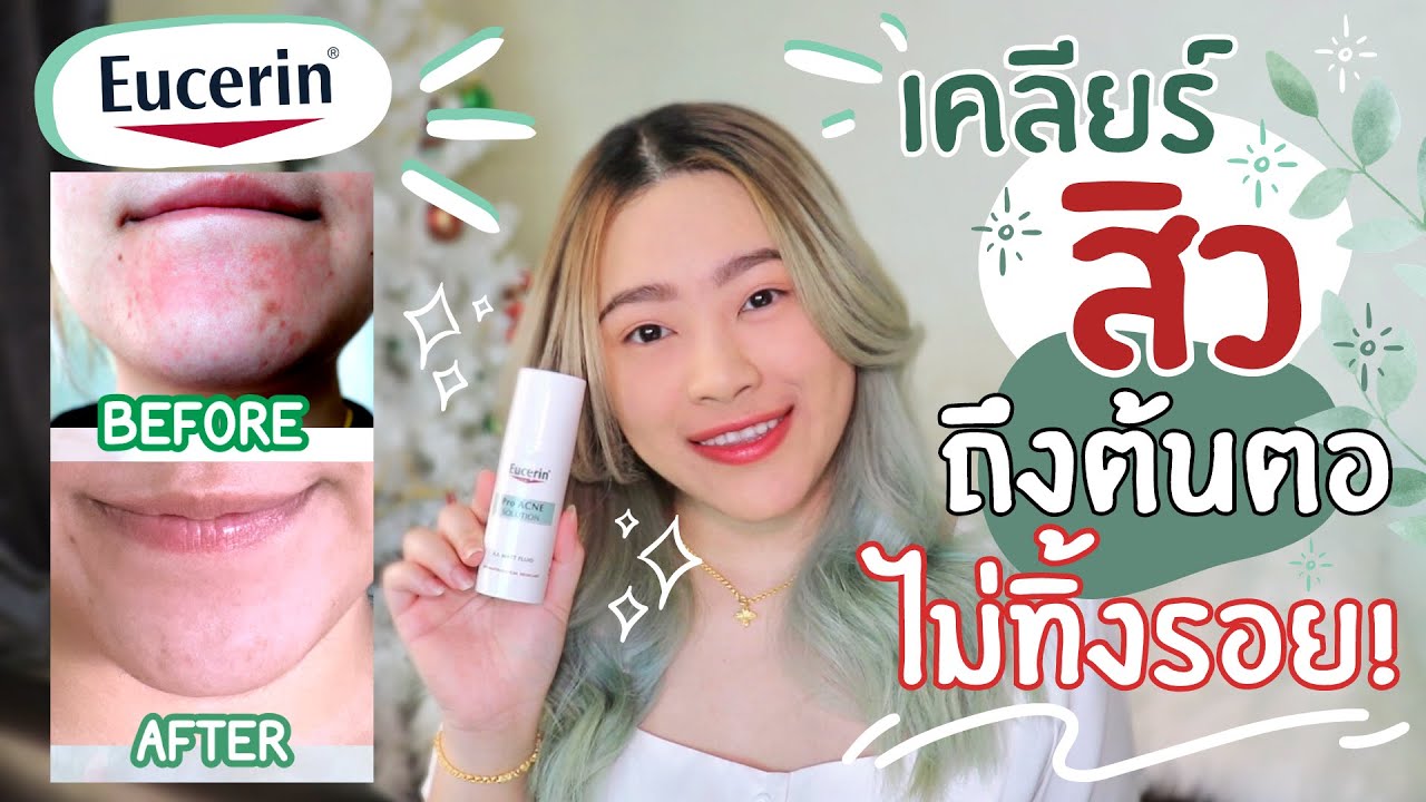 รักษาสิวถึงต้นตอ คุมมัน ไม่ทิ้งรอยสิว  Eucerin A.I. Matt Fluid ขวดเดียวเอาอยู่ l nownow p.