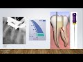 Step by step procedure of BMP with rotary files in a molar tooth( in Hindi)