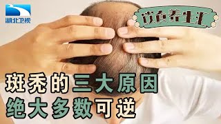 三种原因可能导致斑秃,秃了以后怎么办绝大多数可以重新长出头发【饮食养生汇】
