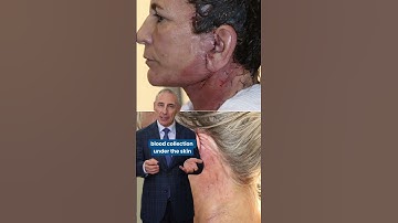 🩺 The most common complication after a facelift?