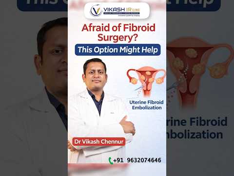Uterine Fibroid Embolization By Dr  Vikash