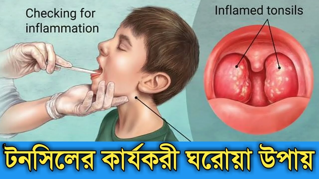 টনসিলের কার্যকরী ঘরোয়া ও হোমিওপ্যাথি চিকিৎসা | tonsillitis home & homeopathy treatment bangla