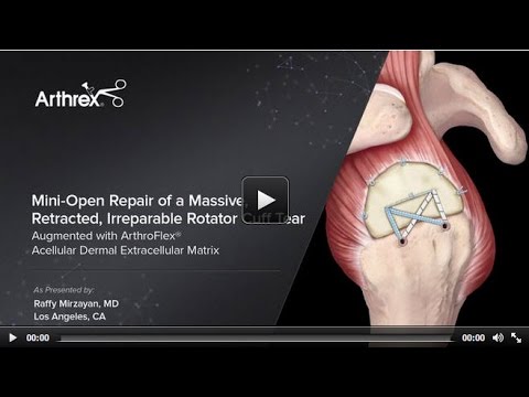Mini-Open Repair of a Massive, Retracted, Irreparable Rotator Cuff Tear