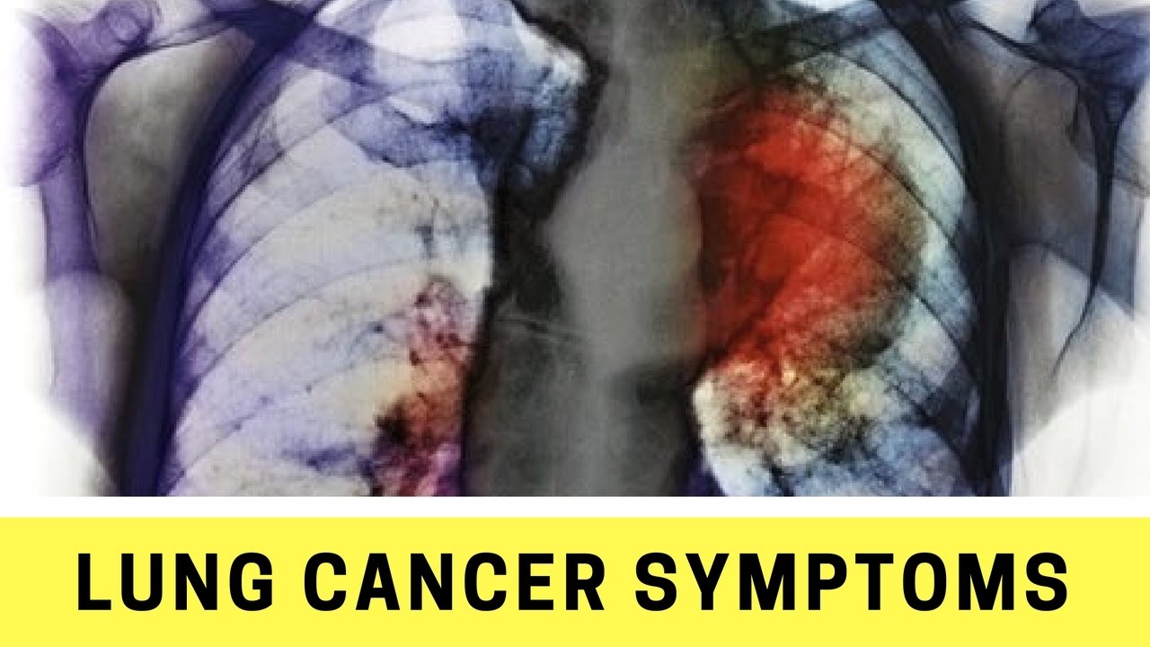 Lung Cancer Symptoms Youtube