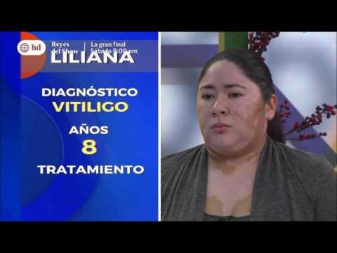 botox meaning Vitiligo manos, pies y cuerpo. Tratamiento DRTV 2016. Lima Peru