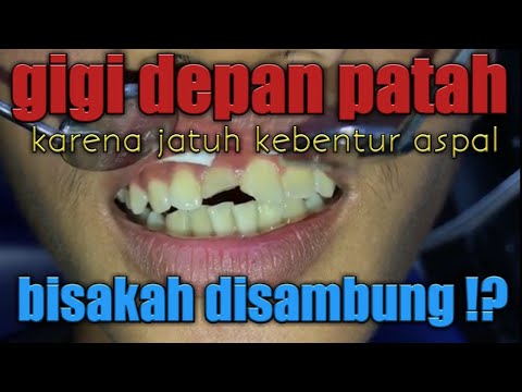 Cara menambal gigi depan yang patah