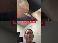 Enormous blister peeling  shorts blister jawspodiatry