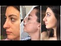 1- 6 months rhinoplasty update | month by month nose job  recovery|