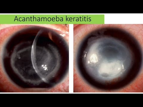 Video: Acanthamebic Keratit - Symptom, Behandling, Former, Stadier, Diagnos