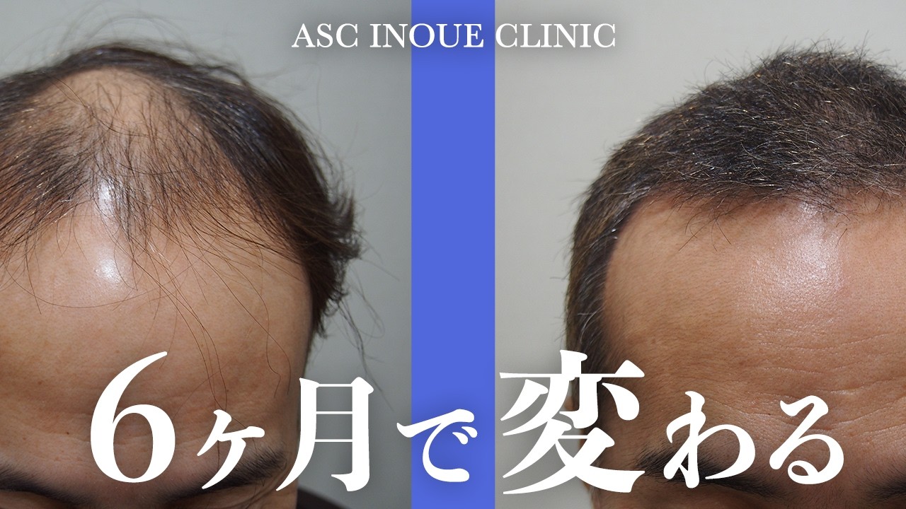 男性 生え際から頭頂部 2 800グラフト 自毛植毛アスク井上クリニック症例 Youtube