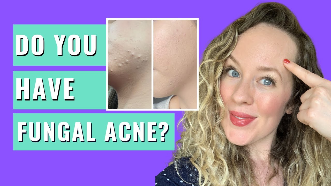 Malassezia Folliculitis - DO YOU HAVE FUNGAL ACNE? FUNGAL ACNE SIGNS