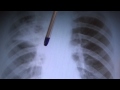 Виды туберкулеза на рентгене