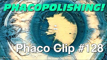 Phaco Clip #128 - Soft Cortical and Cortex Phacoaspiration