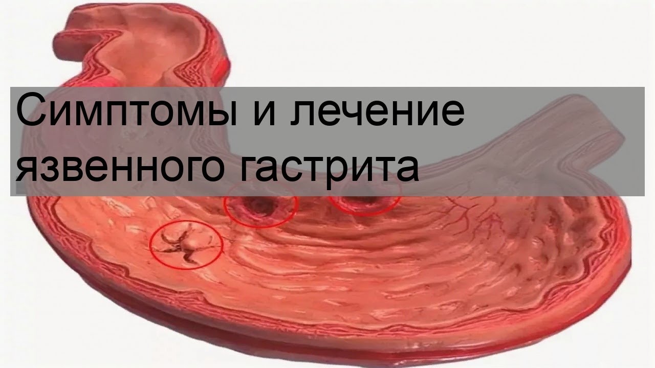 Симптомы и лечение язвенного гастрита - YouTube