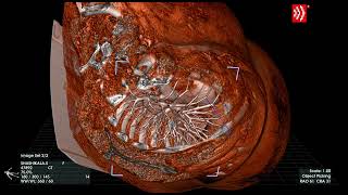 Anatomy Of The Sinus Venosus Asd