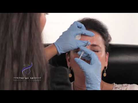 Videó: Botox injekciók 40 éves korig: előnyök és hátrányok