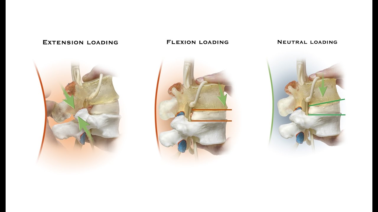 The biomechanics of back pain