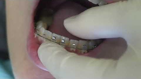 tháo nắp mắc cài sứ tự buộc Clippy-C TOMY