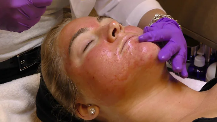 Learn More about Microneedling with Platelet Rich ...