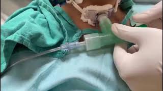 Speaking T-Piece with Tracheostomy