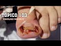 PARA OS AMANTES DAS UNHAS, TÓPICO 103 (FOR THE NAIL LOVERS, SUBJECT 103) - PODÓLOGO MAURÉLIO