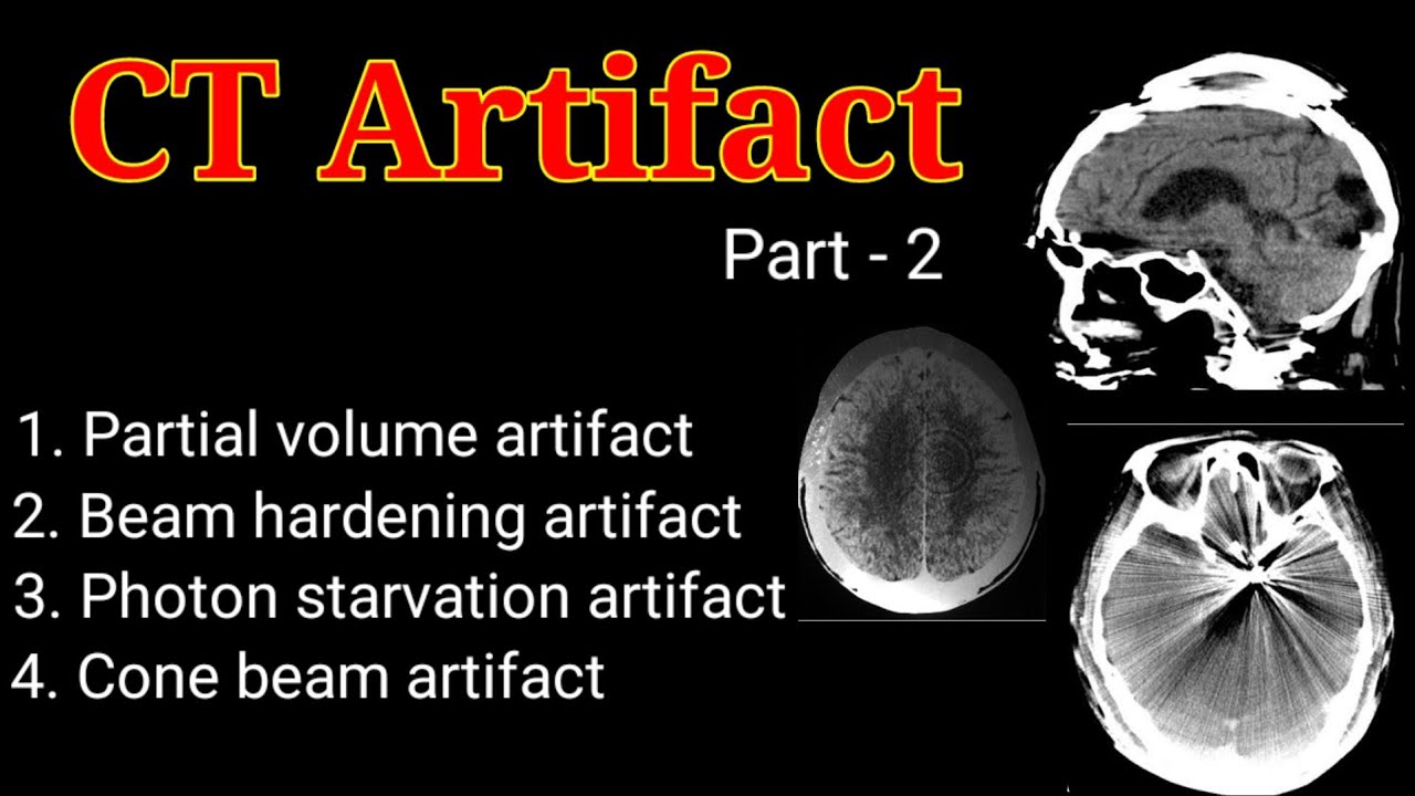 Imaging Artifacts - CT, MRI, and Mammography