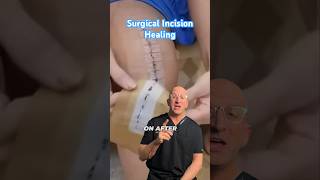 Should Surgical Incisions Be Covered? Uncovered? #shorts