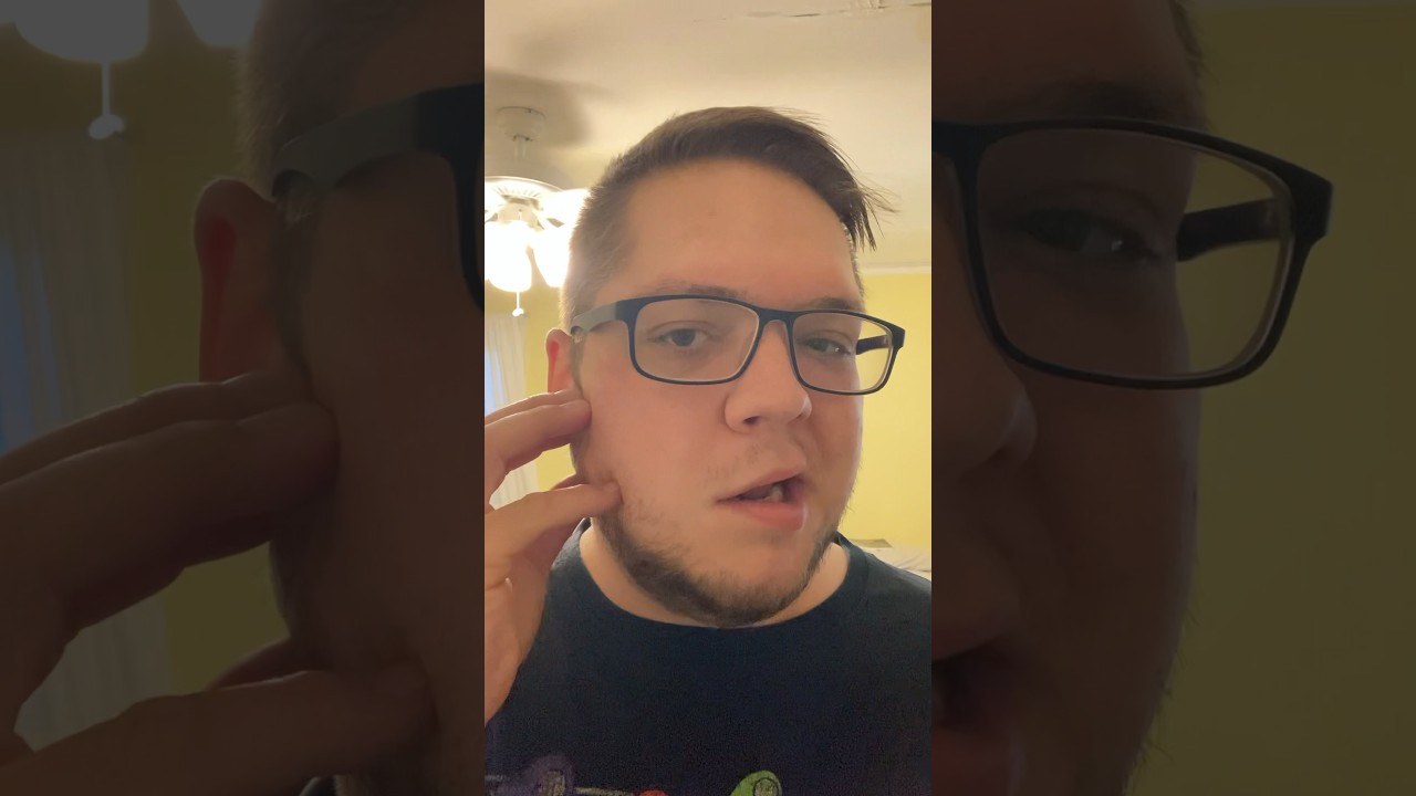 Bell’s palsy day 6 update😏