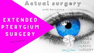 Extended Pterygium Surgery - closer to perfect - with Autograft Dr Anthony Maloof Sydney, Australia