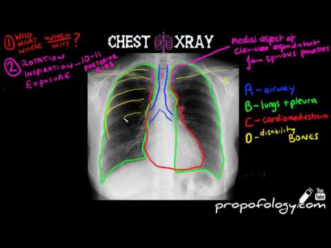 Video: How to Read a Chest X-Ray (with Images)