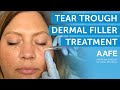 Under Eye Dermal Filler Treatment | AAFE