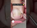 I can’t stop watching this video! #satisfying #ingrowntoenail #pedicure #pedicuretraining