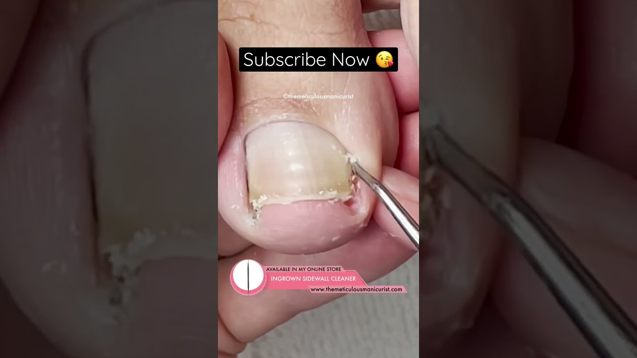 I Can T Stop Watching This Video Satisfying Ingrowntoenail Pedicure Pedicuretraining