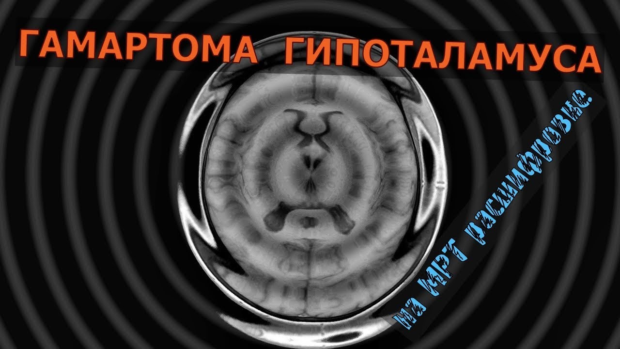 ГАМАРТОМА ГИПОТАЛАМУСА на расшифровке МРТ головного мозга проф. Холиным Александром Васильевичем