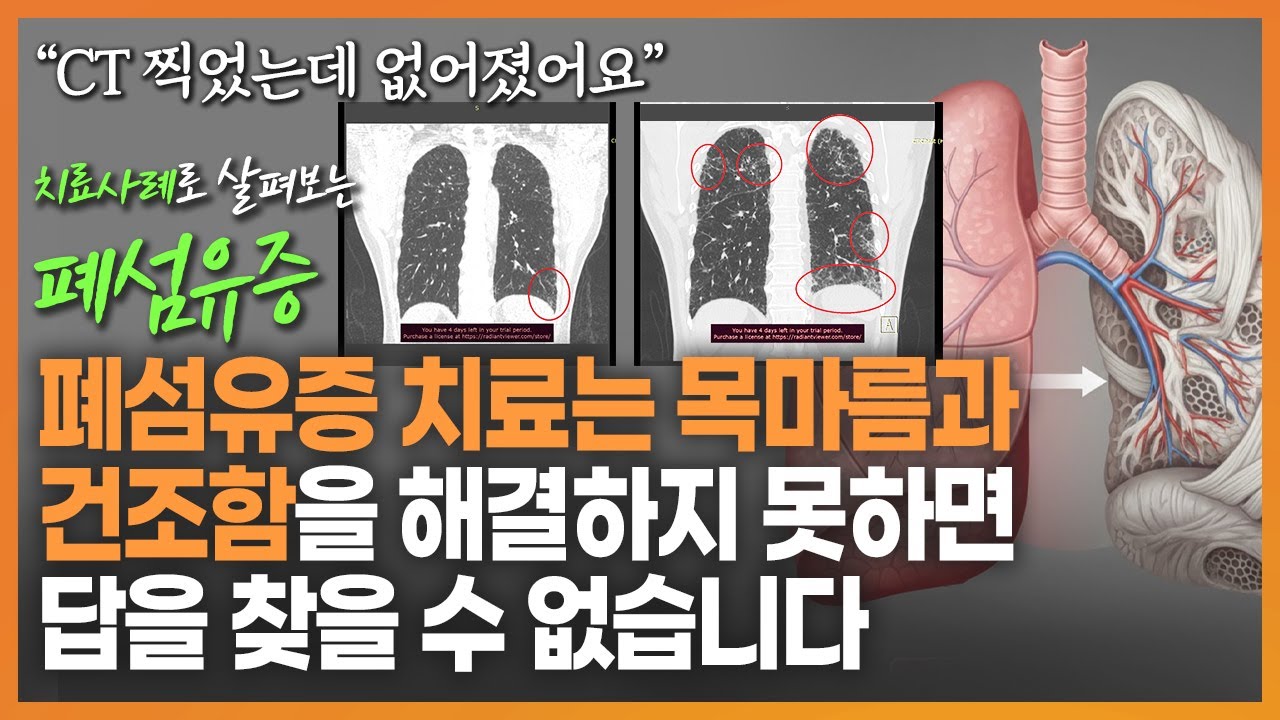 폐섬유증 치료 사례 소개  |  폐섬유증은 목마름과 건조함을 해결하지 못하면 답을 찾을 수 없습니다