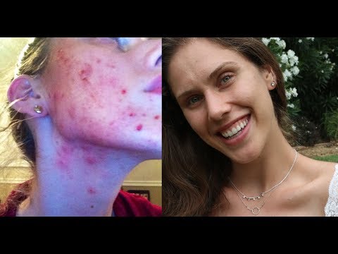 Como ter a certeza Com Acne