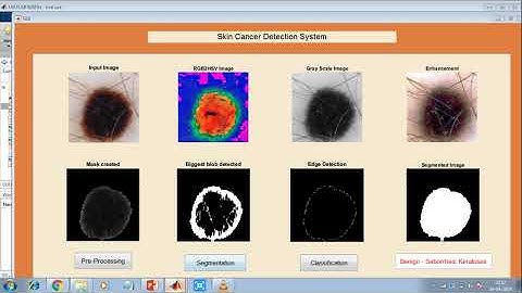 skin lesion detection system using Matlab | image processing | machine learning | skin | cancer