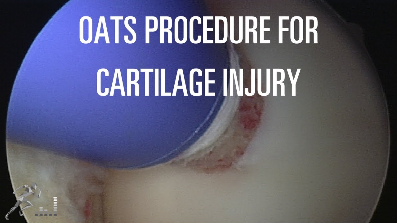 Cartilage injury and surgery Osteochondral transfer YouTube
