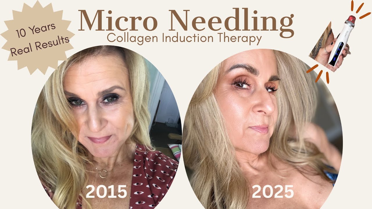 How Microneedling Transformed My Skin! 10 Years of Experience in 10 Min!