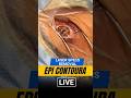 LIVE EPI Contoura Specs Removal Surgery