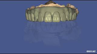Full arch designing for upper  all on x in exocad elefsina - best laser dental -chennai
